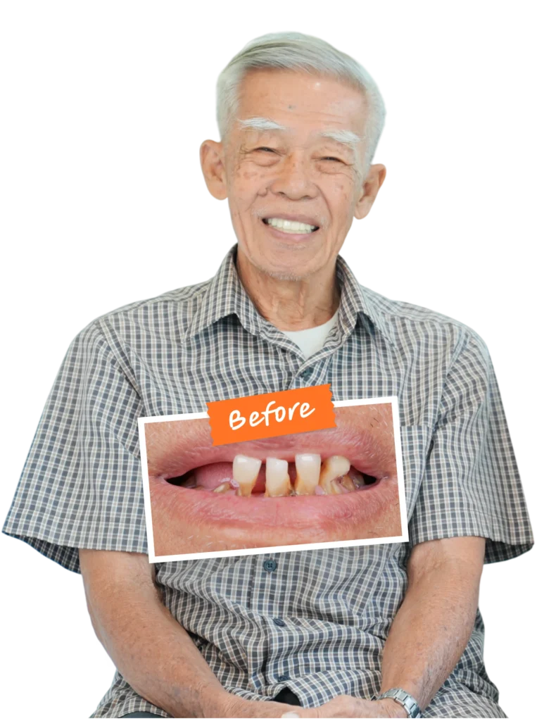 รากฟันเทียม all on 4 รีวิว